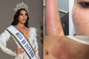 Reina de belleza dominicana sobrevivió de milagro a una explosión de olla de presión